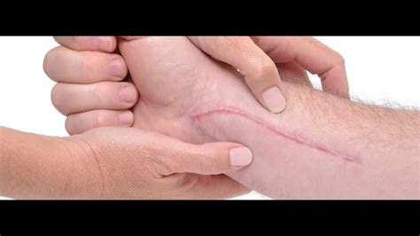 Stop when there is a straight line from. . How to stop internal scar tissue from growing
